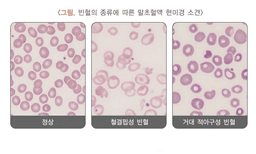 [질병관리청] 빈혈